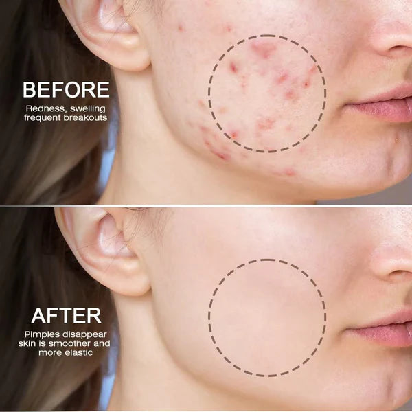 Snmifun Anti-Acne Gel